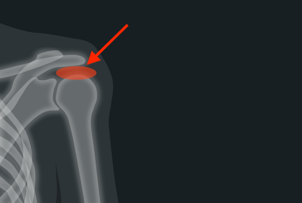 schulterimpingement-physiotherapie-achim