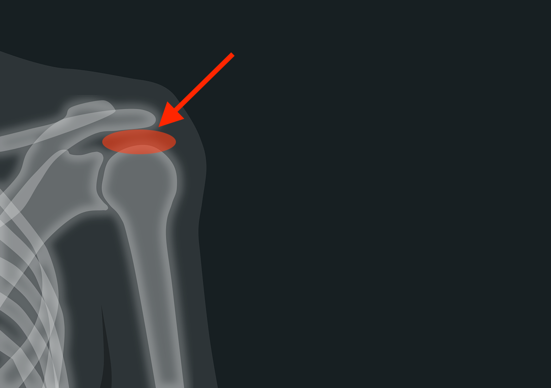 Schulterimpingement-Wenn der Schleimbeutel meckert!